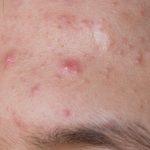 pimple
